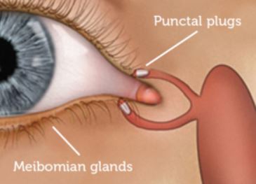 Punctal Plugs graphic with human eye