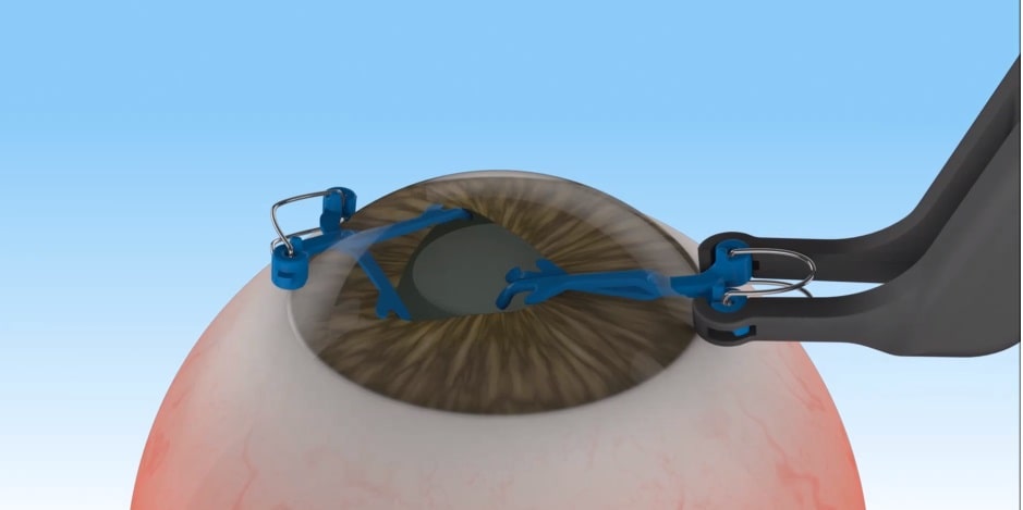graphic of a pupil expander and how micro intraocular implant medical devices work